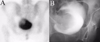 Bladder Carcinoma