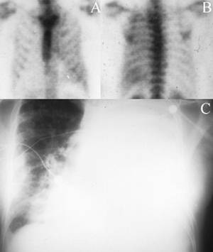 Pleural Effusion