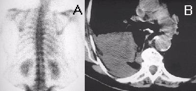 Malignant Pleural Effusion