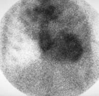Amyloidosis