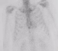 Ischemic cardiomyopathy