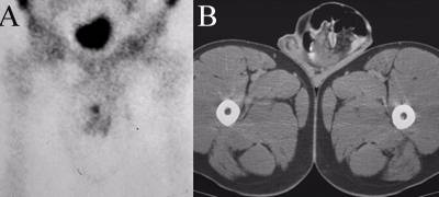Scrotal Hernia