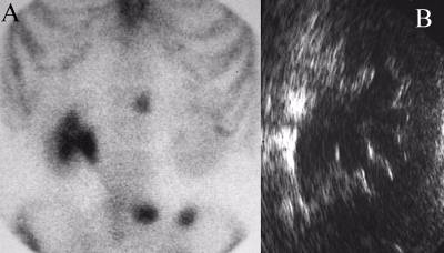 Hydronephrosis