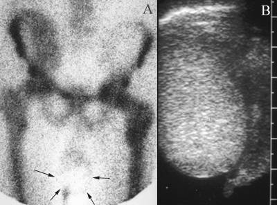 Hydrocele