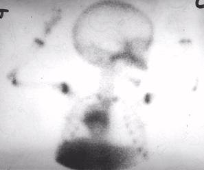 Neuroblastoma (Ant Chest)