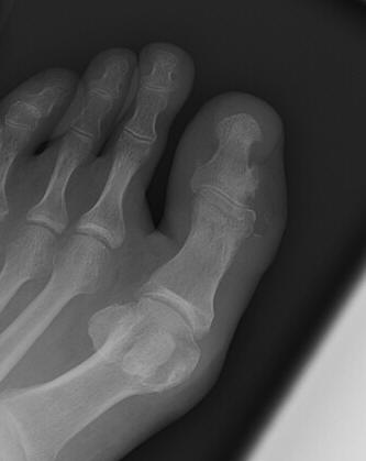 infect1xray.jpg