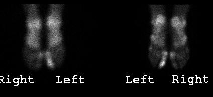 Osteomyelitis, delayd images of a bone scan