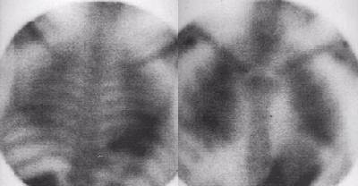Lung uptake in hyperparathyroidism