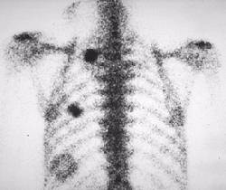 Metastatic Osteosarcoma
