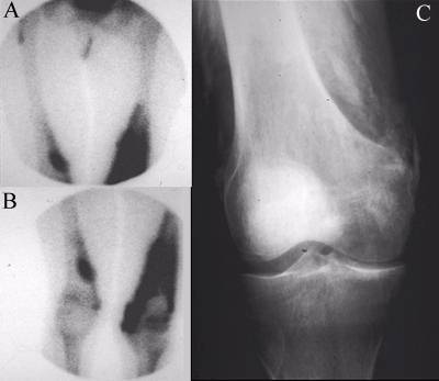 Myositis Ossificans