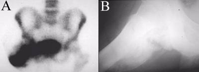 Myositis Ossificans
