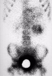 Neuroblastoma