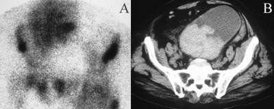 Prostate Ca