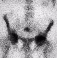 Prostate Hypertrophy