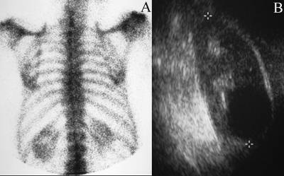 Renal Cyst