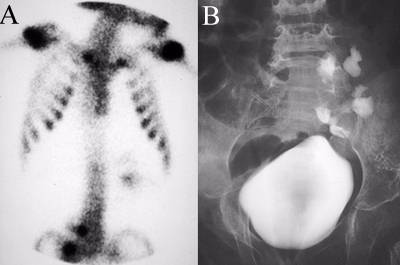 Pelvic Kidney