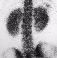 Sickle Cell