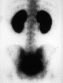 Hypercalcemia