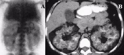 Polycystic Kidney