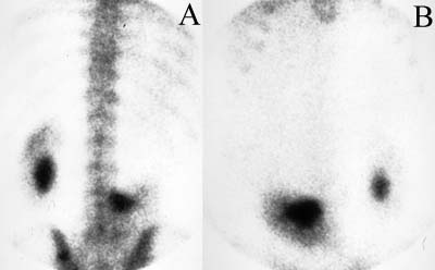 Ptotic Kidney