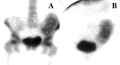 Renal Transplant