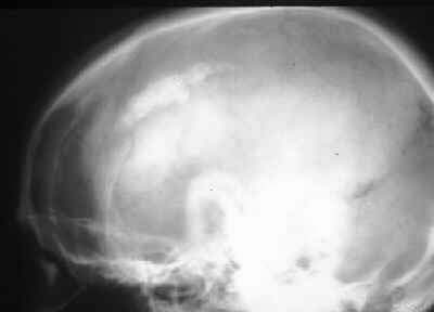 Dural Calcification