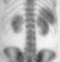 Splenic infarct