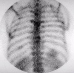 Splenic Infarct