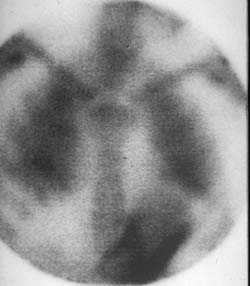 Hyperparathyroidism
