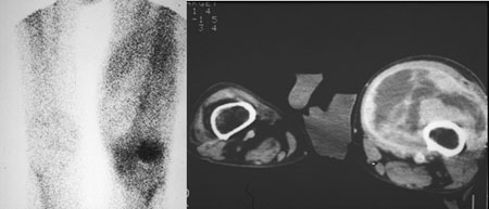 Soft Tissue Sarcoma