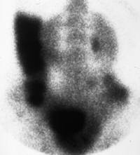 Ureterosigmoidostomy